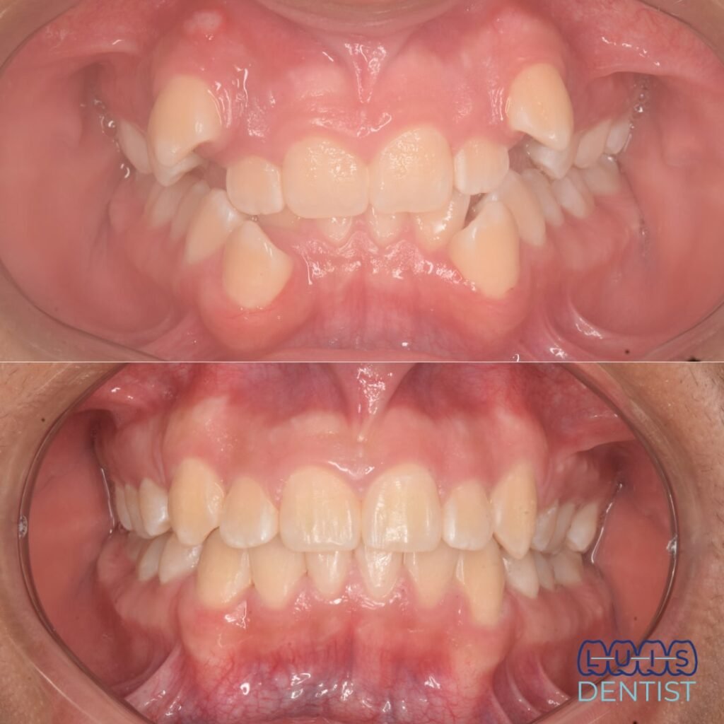 Antes - Alineación dental en dentición mixta
