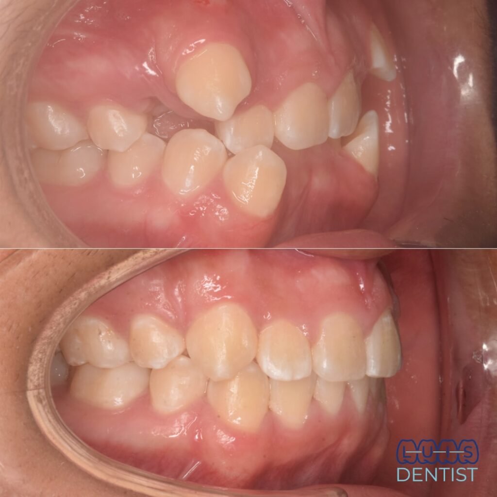 Después - Alineación dental en dentición mixta