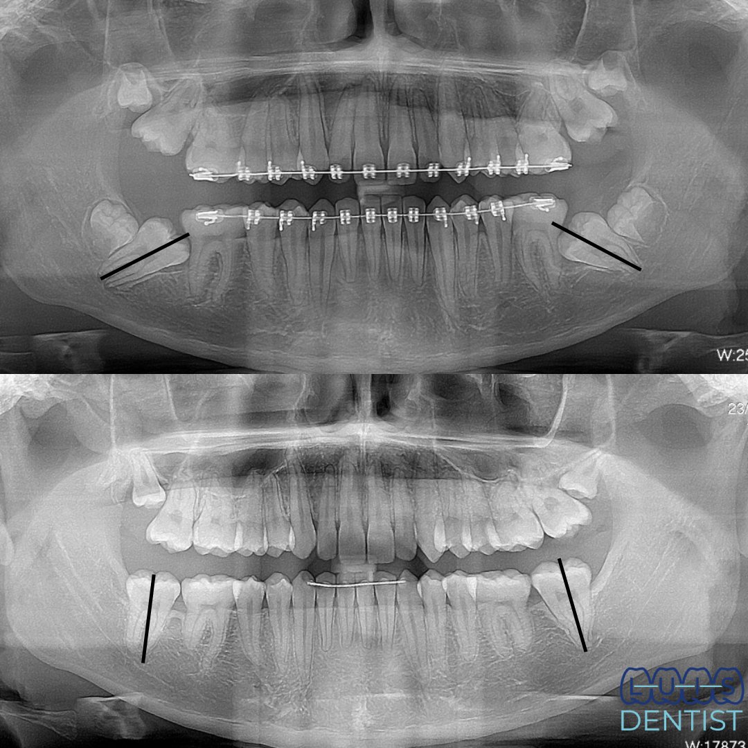 Después - 2da Molar impactada