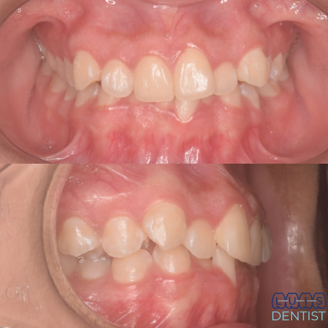 Antes - Clase 2 dentaria