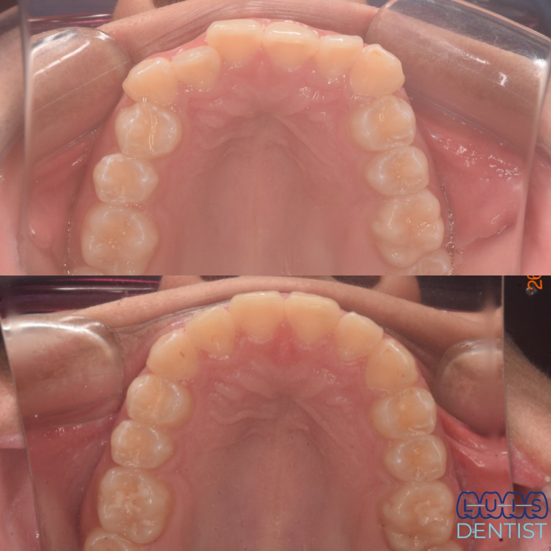 Durante - Clase 2 dentaria